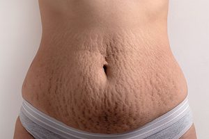 Read more about the article Do Stretch Marks Go Away with Weight Loss?