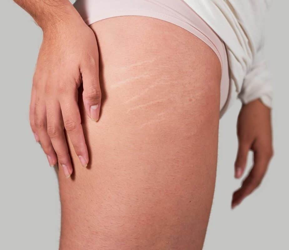 Do Stretch Marks Go Away When You Lose Weight?