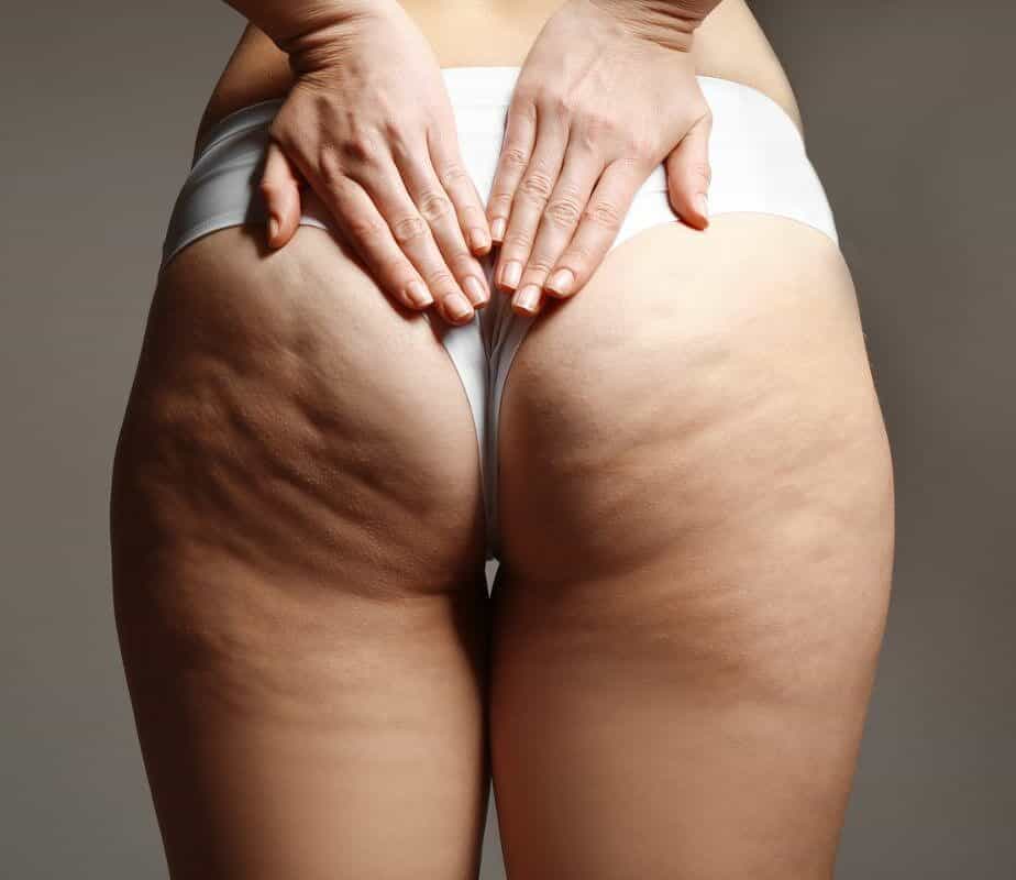 Read more about the article How To Get Rid Of Fat Under Your Butt